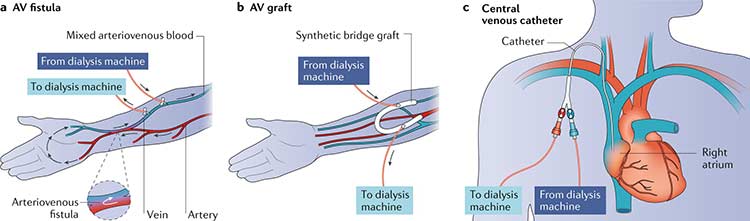 مقایسه انواع دسترسی عروقی دیالیز