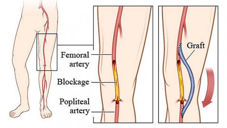 جراحی بای پس رگ پا
