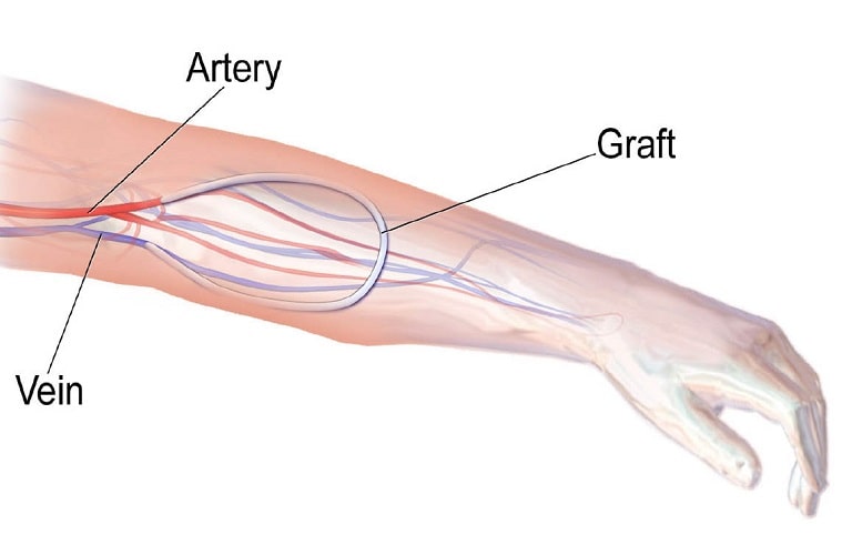 گرافت شریانی وریدی
